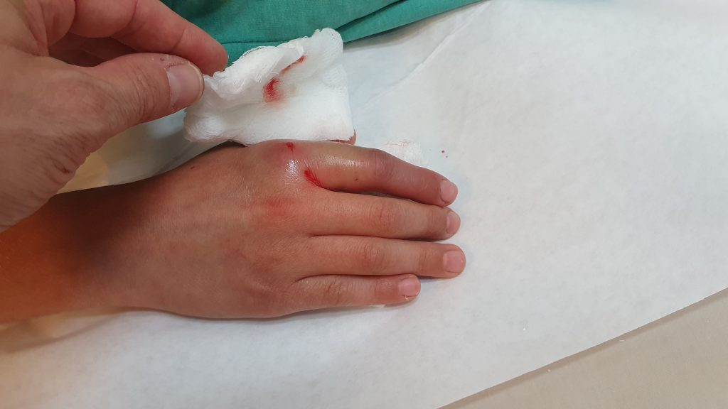 Jojo Dislocated Finger